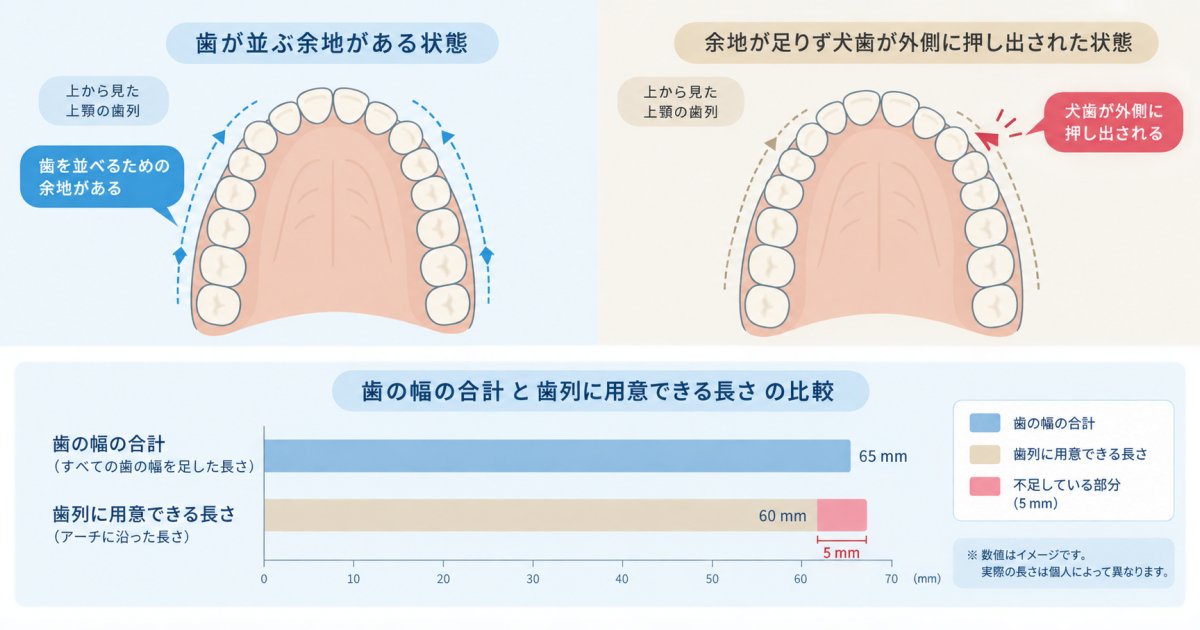八重歯ができる原因と抜歯が必要になる場合との違い