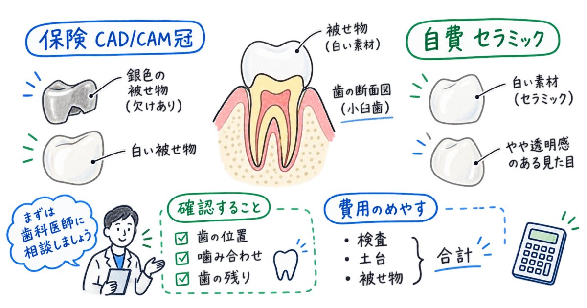 欠けた銀歯を白くしたい｜保険でできる条件と自費の費用・選び方
